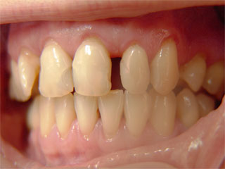 Zahnarzt München: Zahlücken mit Kunststoff reparieren