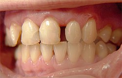 Lückenschluss mit Adhäsivkunststoff Füllungen Zahnarzt München Lückenschluss mit Adhäsivkunststoff Füllungen Zahnarzt München