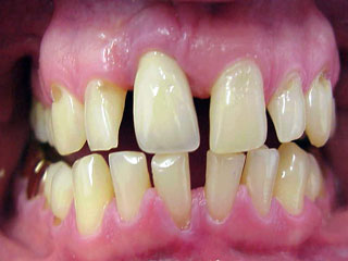Zahnarzt München: grosse Zahnlücke mit Adhäsivkunststoff 