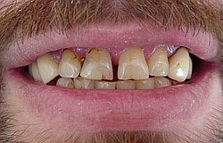Verschönerung der Zähne mit ästhetischen Füllungen Zahnarzt München
