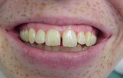 Frontzahnlücke mit Kunststoff korrigiert Zahnarzt München