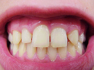 Zahnarzt München: Kleine Zahnkorrekturen machen Menschen glücklichen
