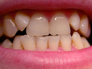 Kleine Zahnfehlstellungen oder zu kleine Zähne kann durch ästhetische Kunststofffüllungen korrigieren.