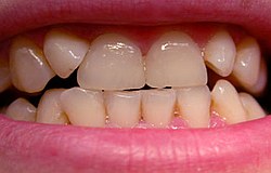 zu kleine Zähne korrigieren mit Zahnfüllung Zahnarzt München