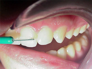 Zahnarzt Mnchen:  Zwischen den Achseln zwischen den ...... zwischen den Zhnen fhlen sich Bakterien wohl. Die Interdentalbrste macht Schluss damit. 