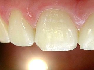 Zahnarzt München: Kariesdiagnose mit Durchlicht Methode sicher und schonend