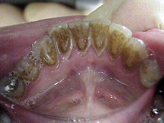 professionelle Zahreinigung entfern Verfärbungen Zahnbeläge Zahnarzt München: Verfärbungen Ablagerungen werden poliert