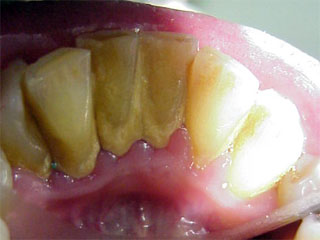 Zahnstein Entfernung Ultraschall Reinigung 2mal pro Jahr Kassenleistung 