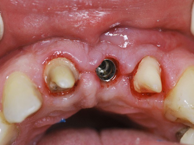Zahnarzt München Implantat statt Brücke