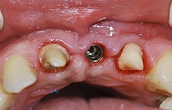 Zahnarzt München: Implantatstatt Brücke Zahnarzt München: Implantatstatt Brücke