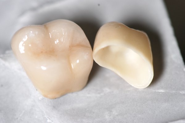 Zahnarzt München Zirkon Krone Cercon CAD CAM Cerec Zirkonium