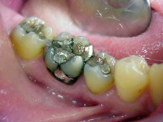 Zirkonkrone metallfrei allergiefrei