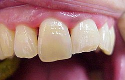 Zahnarzt München: abgebrochener schmerzhafter Zahn was tun ? Zahnarzt München: abgebrochener schmerzhafter Zahn was tun ?