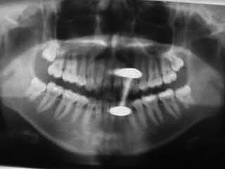 Zahnarzt Mnchen: Bitte legen sie alle metallischen Gegenstnde vor dem Rntgen ab, soweit mglich.