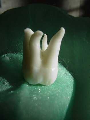 Zahnarzt Mnchen: Manche Zahne haben unntarlich viele Wurzeln. Das kann zu einem Mierfolg der Behandlugn fhren !