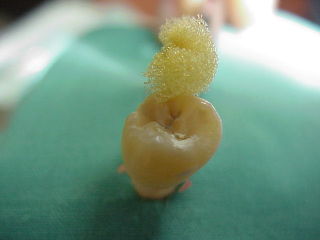 Zahnarzt Mnchen: Die Vitalittsprobe zeigt an ob der Zahn noch lebt.