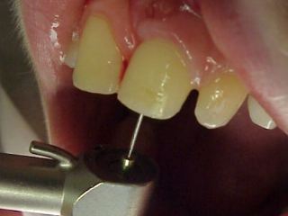Zahnarzt Mnchen: Wurzelbehandlung befreit von Schmerzen die Sie nicht schlafen lassen.