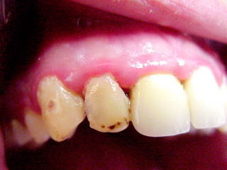 Zahnarzt Mnchen: Schmutz erzeugt Zahnfleisch Entzndungen, Putzen beugt vor