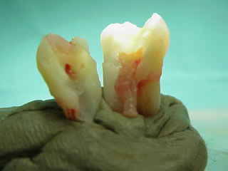 Zahnarzt Mnchen: Der Zahnnerv : Ursprung des Schmerzes